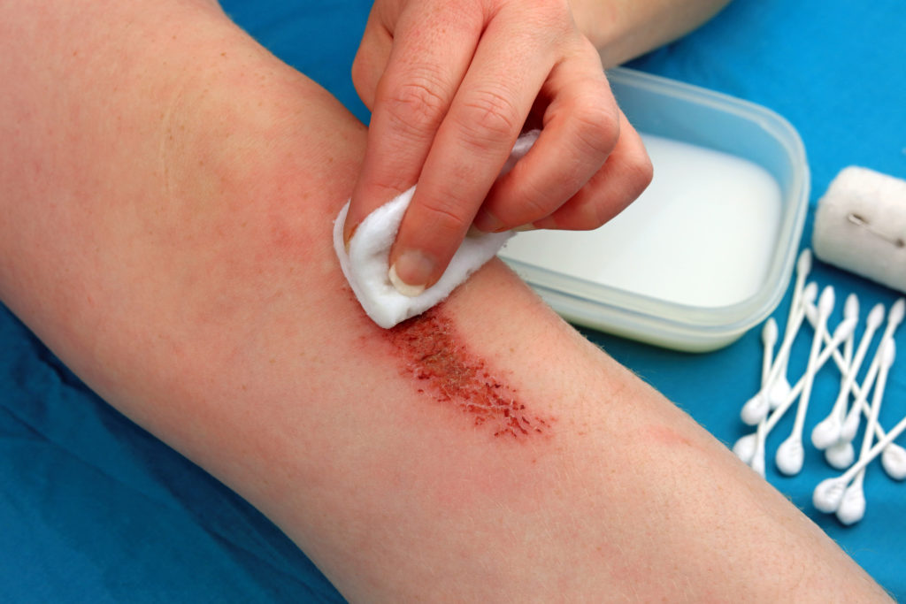 7 Signs a Wound Is Infected (Guide)