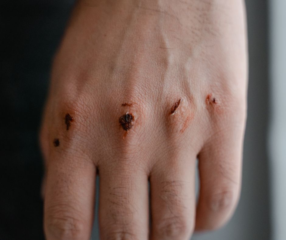 Expert Insights: How Are Open Wounds Treated? Your Comprehensive Guide from Wound-Care.co.uk